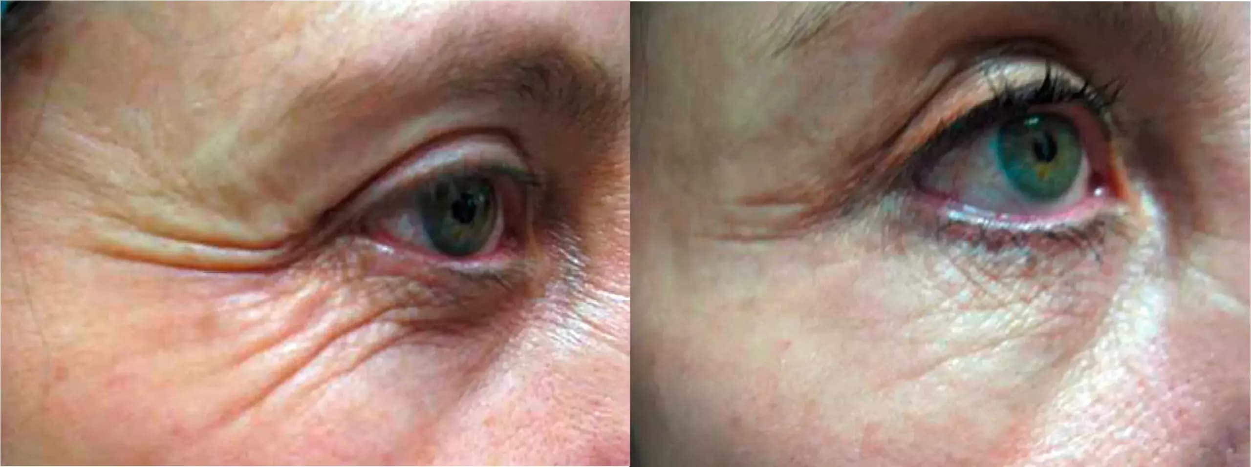 smoothEye.beforeAfterAlt