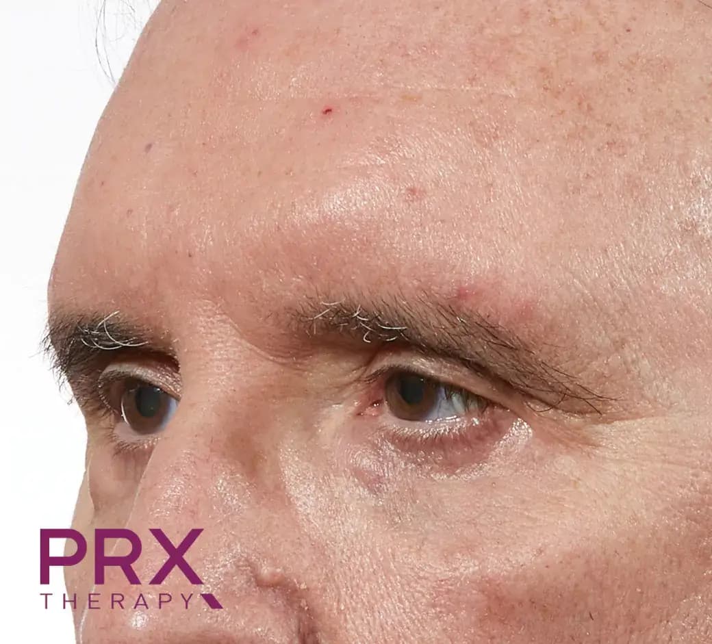 After Glabella