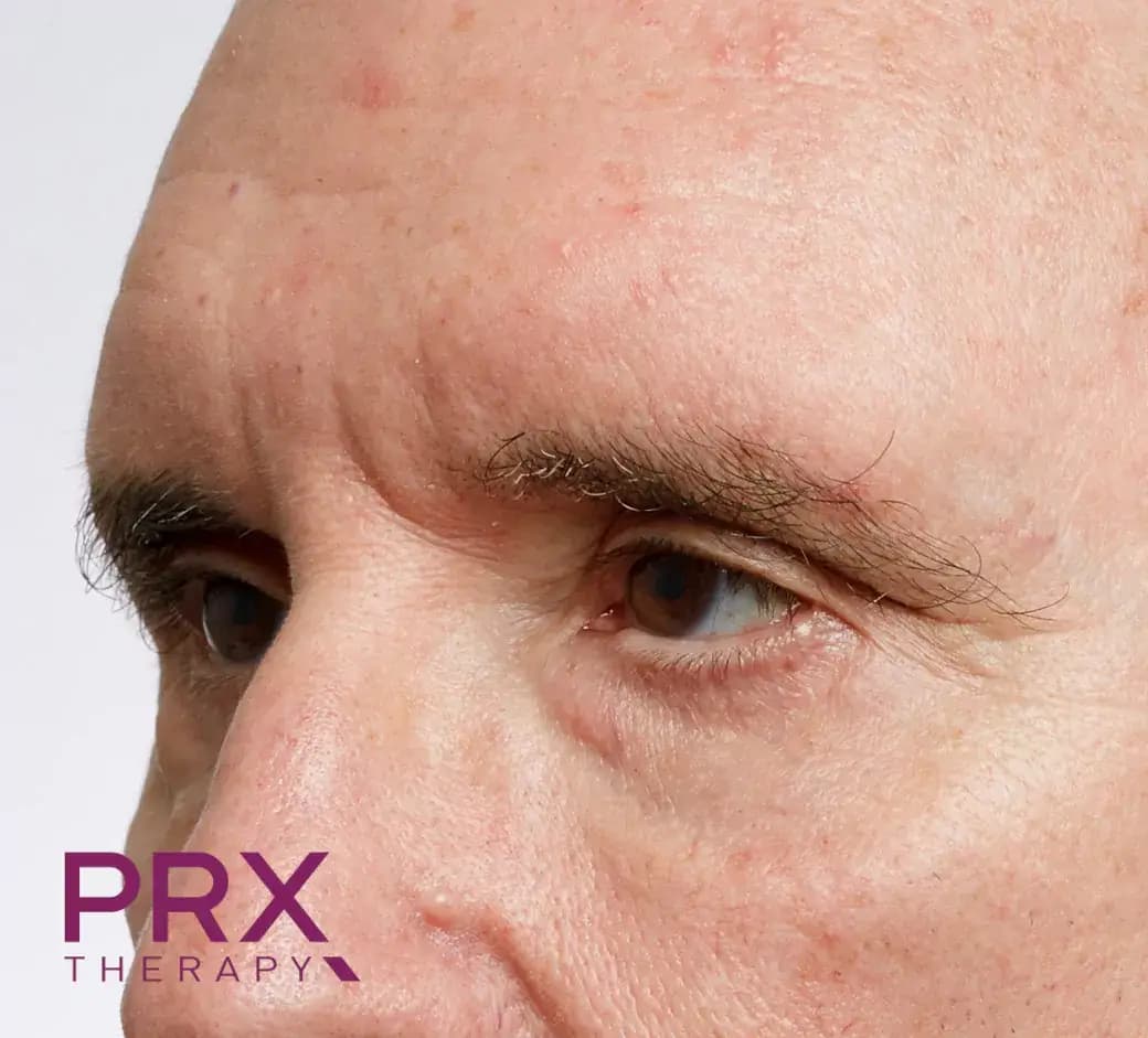 Before Glabella