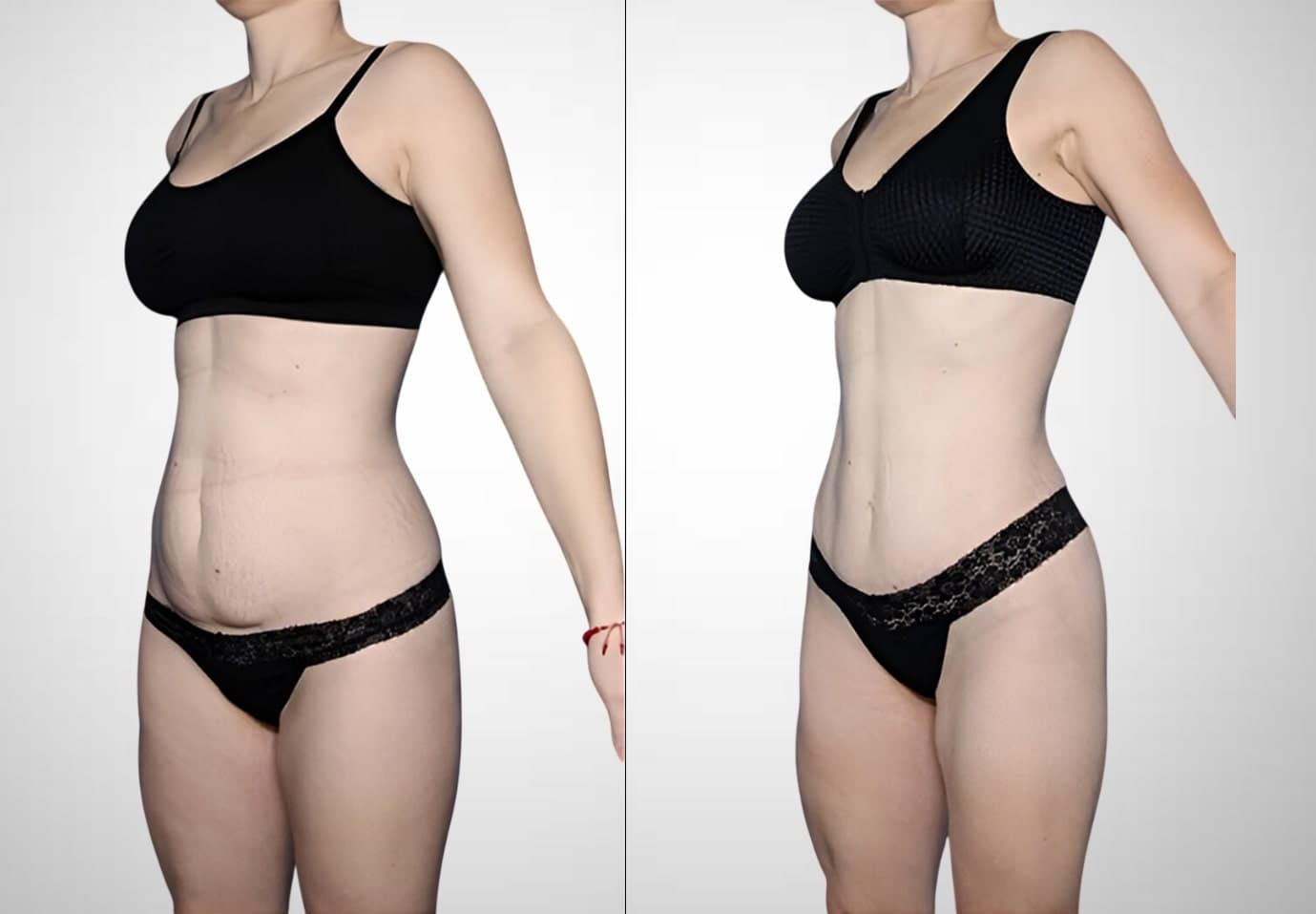 Abdominoplasty result