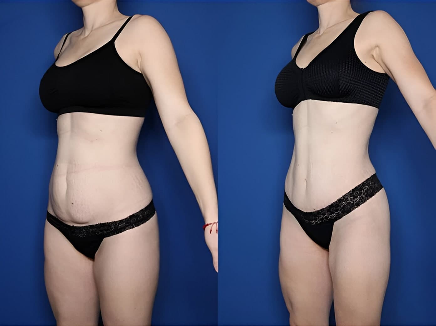 Woman with loose abdominal skin