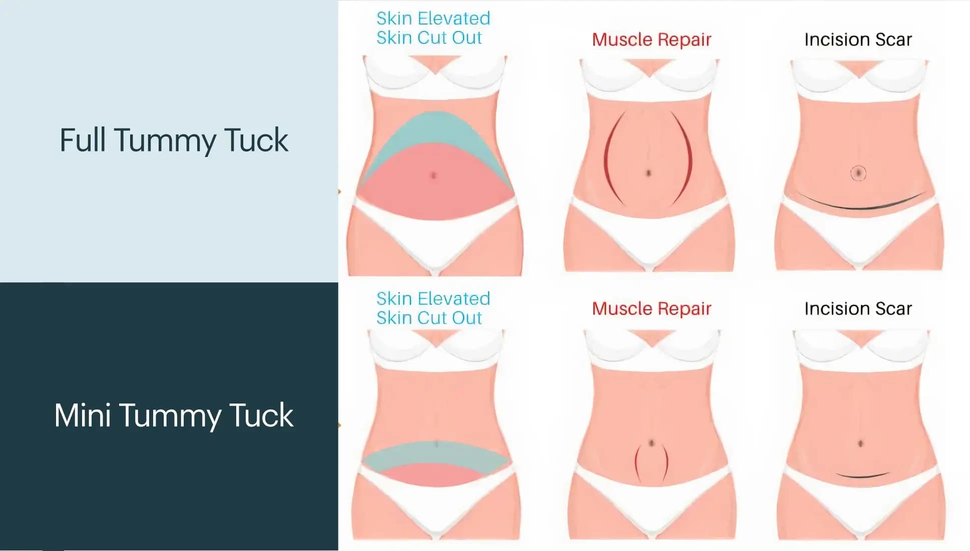 Diagram of tummy tuck incision patterns
