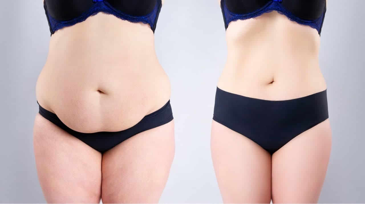 Abdominoplasty procedure