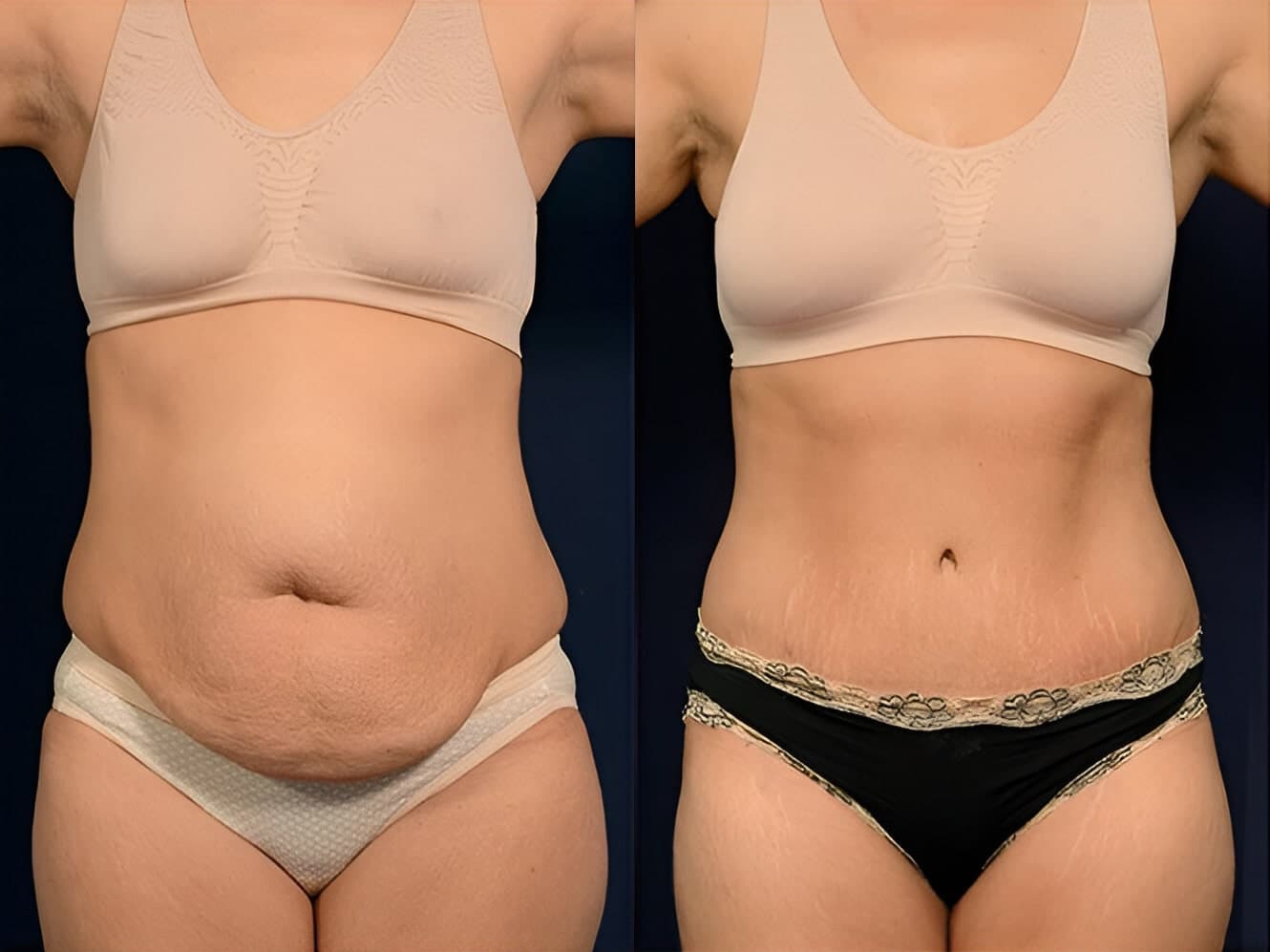 Abdominoplasty before and after