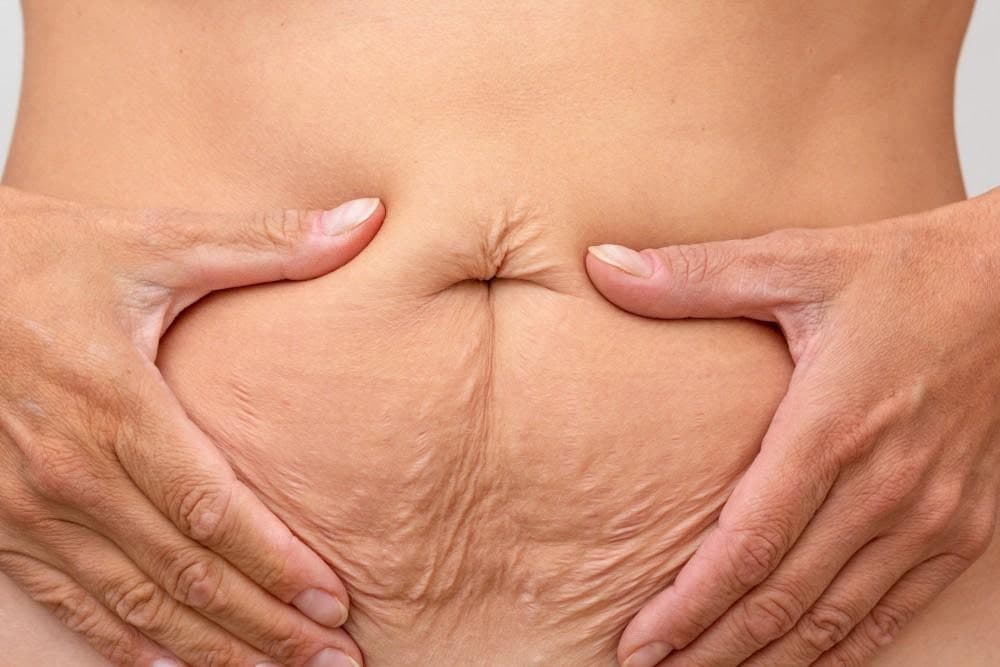 Woman with loose abdominal skin